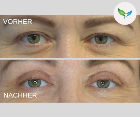Lidstraffung vorher und nachher bilder 36 Vorher-Nachher – Oberlidstraffung mit feinem Resultat