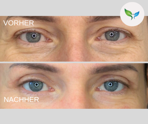 Lidstraffung vorher und nachher bilder 34 Blepharoplastik vorher und nachher – Beispielaufnahme