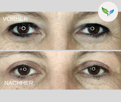Lidstraffung vorher und nachher bilder 32 Oberlidstraffung Vorher-Nachher – deutlich verjüngt