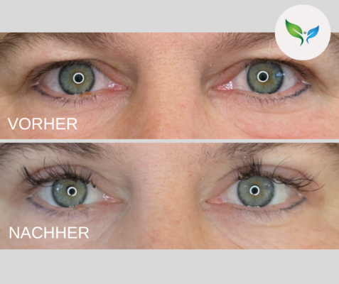 Lidstraffung vorher und nachher bilder 30 Blepharoplastik Vorher-Nachher – sanftes Ergebnis