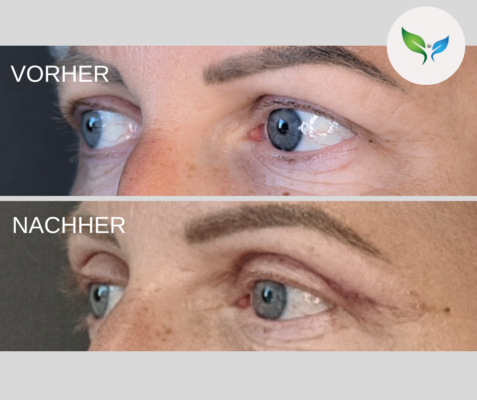 Lidstraffung vorher und nachher bilder 24 Vorher-Nachher Foto – Blepharoplastik Behandlung