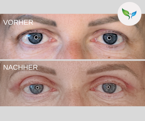 Lidstraffung vorher und nachher bilder 22 Oberlid-Blepharoplastik vorher und nachher – Vorher-Nachher-Ansicht