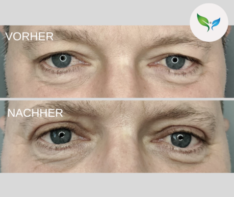 Lidstraffung vorher und nachher bilder 18 Oberlidkorrektur vorher und nachher – subtile Verbesserung