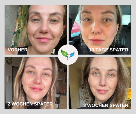 Lidstraffung vorher und nachher bilder 16 Blepharoplastik Vorher-Nachher – ästhetisches Resultat in 3 wochen