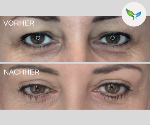 Lidstraffung vorher und nachher bilder 4 Oberlidstraffung - Blepharoplastik – Vorher-Nachher-Vergleich – wunderschöne Korrektur
