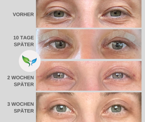 Lidstraffung vorher und nachher bilder 14 Blepharoplastik Vorher-Nachher – ästhetisches Resultat