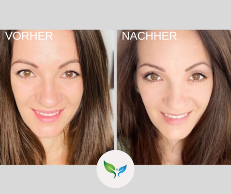 Lidstraffung vorher und nachher bilder 60 Vorher-nachher Bild nach Oberlidkorrektur