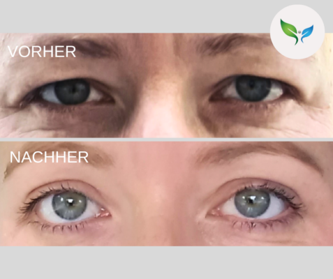 Lidstraffung vorher und nachher bilder 58 Blepharoplastik vorher und nachher – Blick verjüngt