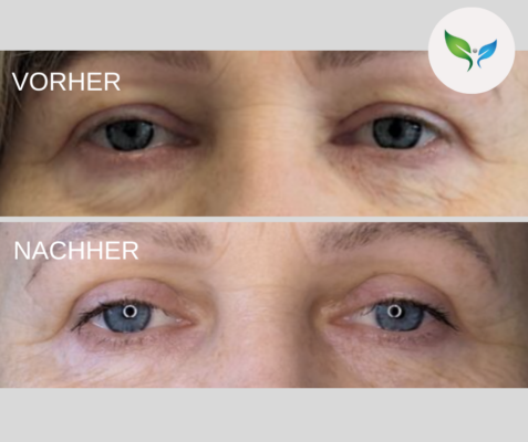 Lidstraffung vorher und nachher bilder 54 Blepharoplastik Ergebnis – Vorher-Nachher Aufnahme