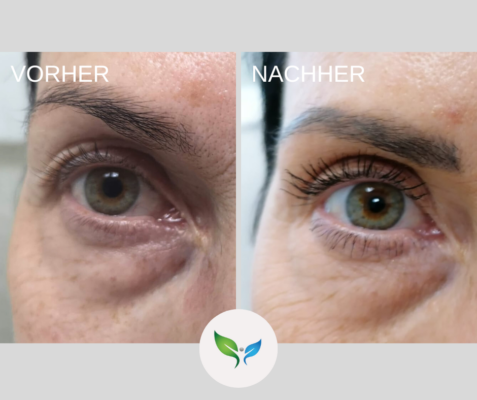Lidstraffung vorher und nachher bilder 52 Lidkorrektur vorher und nachher – Blepharoplastik Beispiel