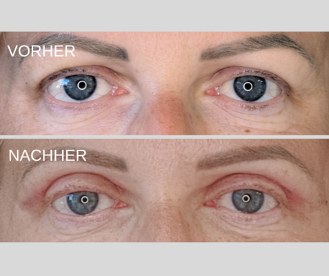 Lidstraffung vorher und nachher bilder 50 Ergebnis nach Oberlidstraffung – Vorher und Nachher