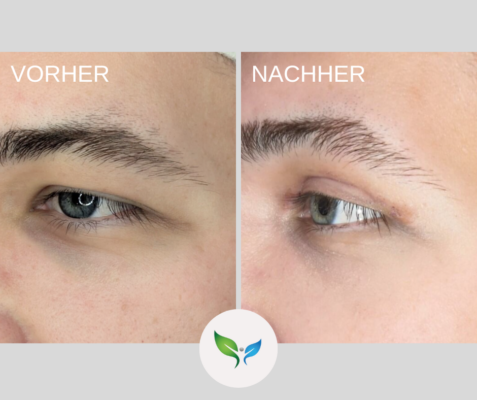 Lidstraffung vorher und nachher bilder 8 Blepharoplastik – Vorher-Nachher-Vergleich – wunderschöne Korrektur