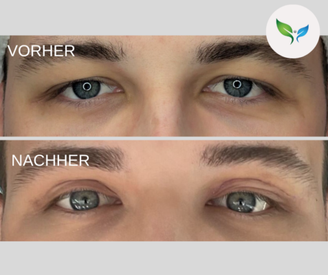 Lidstraffung vorher und nachher bilder 6 Lidkorrektur vorher und nachher Bilder – natürliche Veränderung
