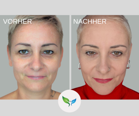 Lidstraffung vorher und nachher bilder 2 Blepharoplastik vorher und nachher – natürlicher Look