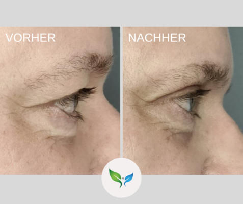 Lidstraffung vorher und nachher bilder 44 Oberlidstraffung Vorher-Nachher – Beispiel der Korrektur