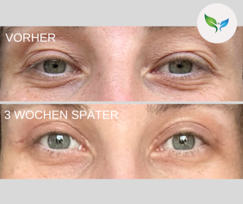 Lidstraffung vorher und nachher bilder 20 Blepharoplastik Vorher-Nachher – ästhetische Veränderung