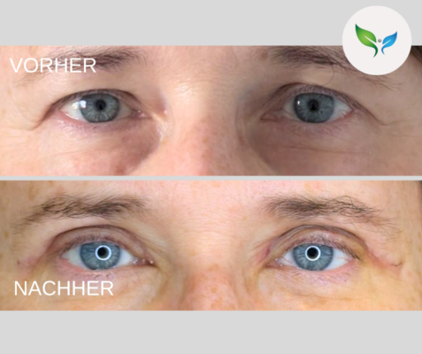 Lidstraffung vorher und nachher bilder 42 Oberlidstraffung Vorher-Nachher – sanfter Effekt