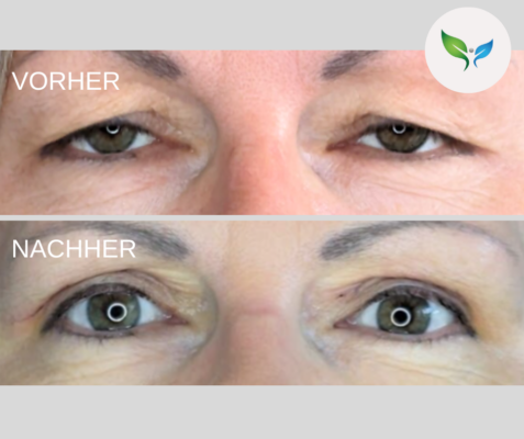 Lidstraffung vorher und nachher bilder 40 Drastische Veränderung – Vor und nach der Blepharoplastik – der Blick wirkt wacher und jünger
