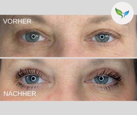 Lidstraffung vorher und nachher bilder 38 Oberlidkorrektur Vorher-Nachher – Ergebnis nach Operation