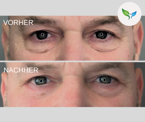 Lidstraffung vorher und nachher bilder 12 Unterlidstraffung Ergebnis – Vorher-Nachher Darstellung