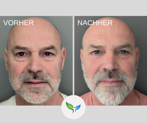 Lidstraffung vorher und nachher bilder 10 Ergebnis Unter-blepharoplastik – Vorher und Nachher