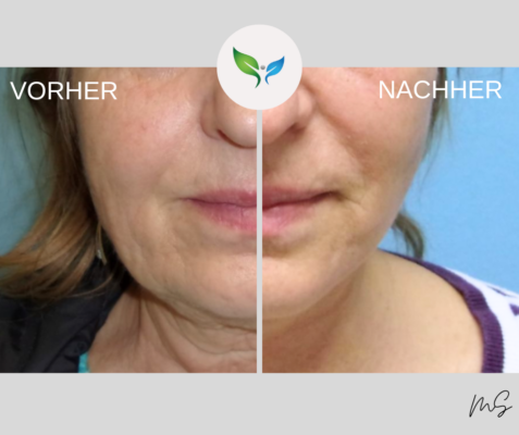 Facelift und Necklift vorher und nachher – Beispiel einer SMAS Technik