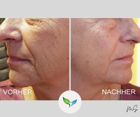 SMAS Facelift – Vorher-Nachher Aufnahme, sanfte Straffung