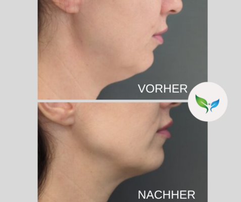 Fettabsaugung Vorher und Nachher Bilder 50 Fettabsaugung Doppelkinn – Vorher-Nachher Aufnahme