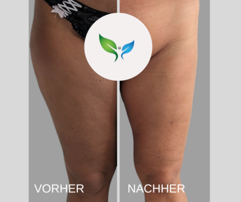 Fettabsaugung Vorher und Nachher Bilder 12 Fettabsaugung Oberschenkel – natürliches Vorher-Nachher Ergebnis
