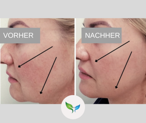 Mini Facelift – Vorher-Nachher Aufnahme, sanfte Straffung