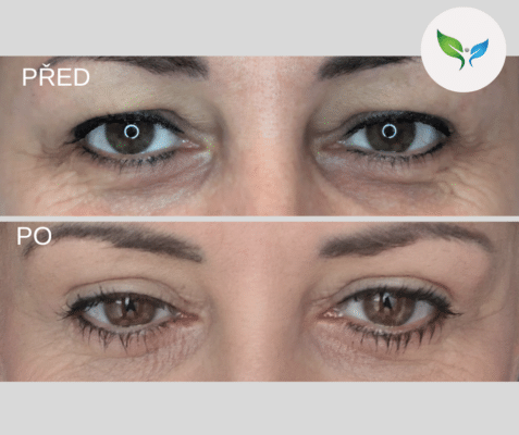 Blefaroplastika - operace horních víček před a po na klinice My Best Care