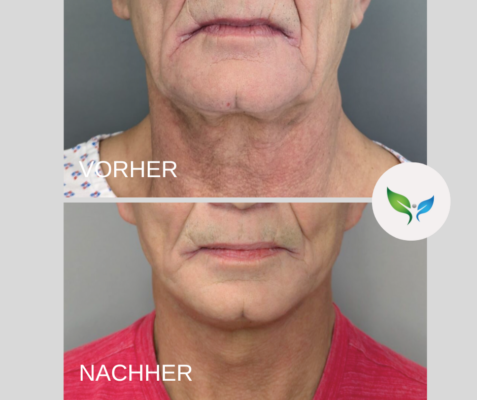 Vorher-Nachher Vergleich nach SMAS Facelift und Necklift