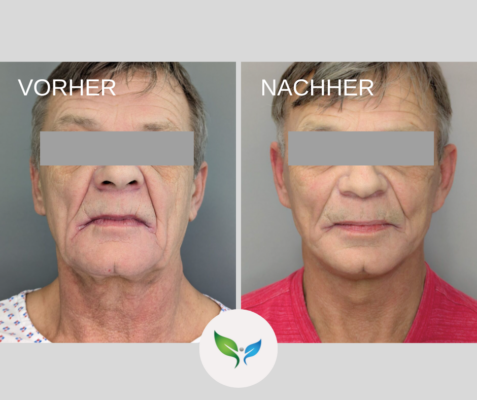SMAS Facelift und Necklift vorher und nachher – sichtbare Verjüngung