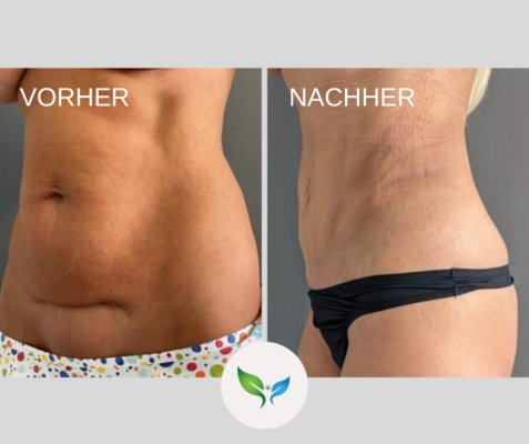 Vorher-Nachher – Mini-Bauchdeckenstraffung und Fettabsaugung am Bauch