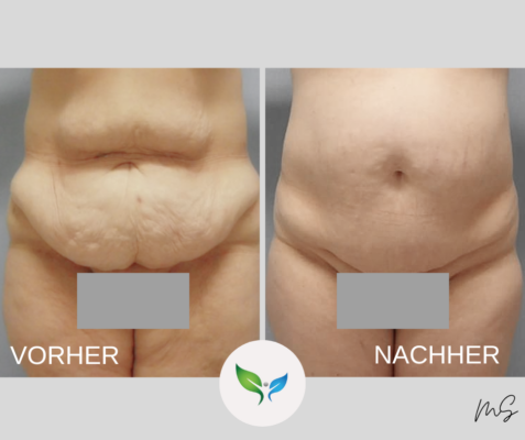 Bauchdeckenstraffung vorher und nachher – kombiniert mit Liposuktion