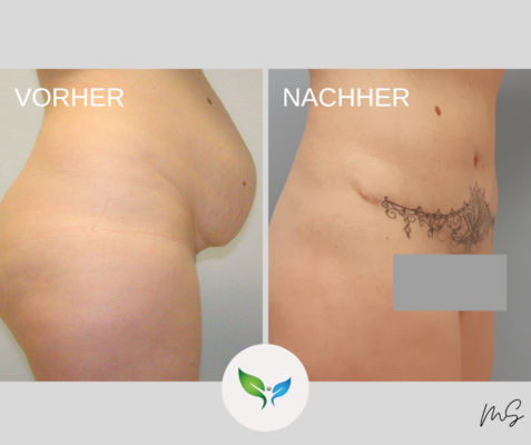 Bauchdeckenstraffung und Liposuktion – vorher und nachher Ergebnis
