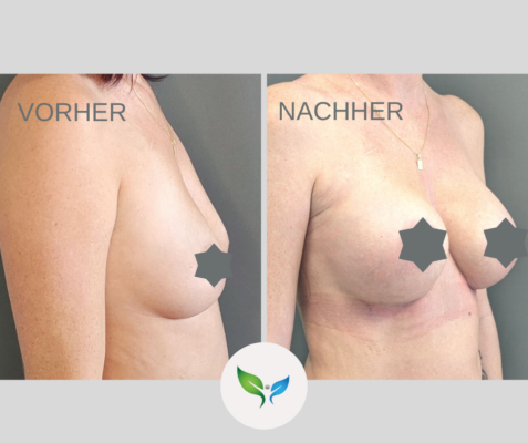 Brustvergrosserung Vorher und Nachher Bilder 24 Brustaugmentation vorher und nachher – harmonisches Ergebnis