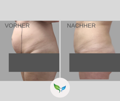 Fettabsaugung Vorher und Nachher Bilder 52 Fettabsaugung an Bauch und Hüften – deutliche Vorher-Nachher Veränderung