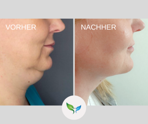Vorher-Nachher Vergleich nach Fettabsaugung am Doppelkinn