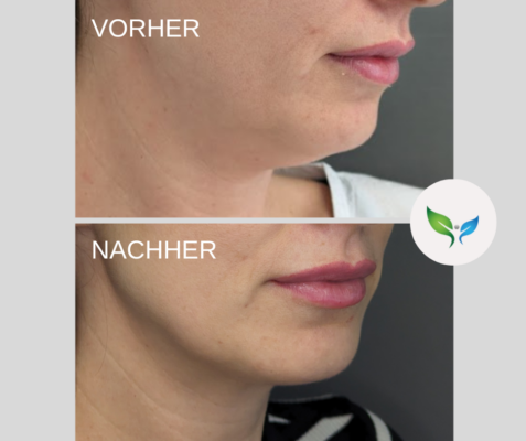 Fettabsaugung Vorher und Nachher Bilder 18 Fettabsaugung am Doppelkinn – Vorher-Nachher Ergebnis, definierter Hals