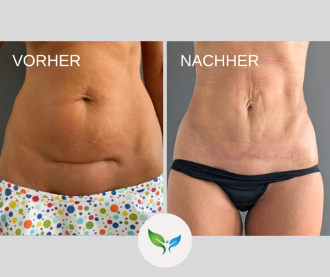 Fettabsaugung Vorher und Nachher Bilder 40 Mini-fettabsaugung am Bauch – ästhetisches Vorher-Nachher Ergebnis