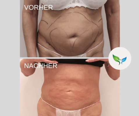 Fettabsaugung Vorher und Nachher Bilder 38 Vorher-Nachher Fotos – Fettabsaugung am Bauch mit harmonischem Effekt