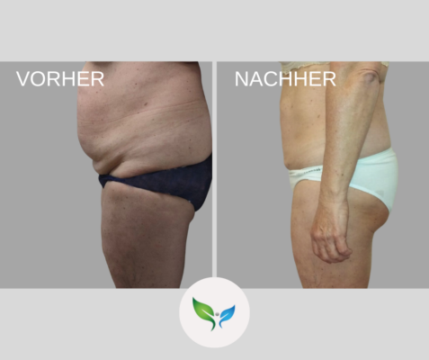 Fettabsaugung Vorher und Nachher Bilder 36 Fettabsaugung am Bauch – natürliches Vorher-Nachher Ergebnis