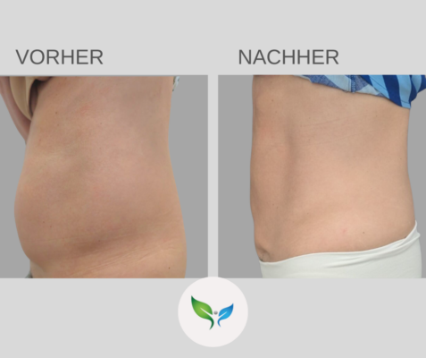 Fettabsaugung Vorher und Nachher Bilder 32 Vorher-Nachher Vergleich nach Fettabsaugung am Bauch