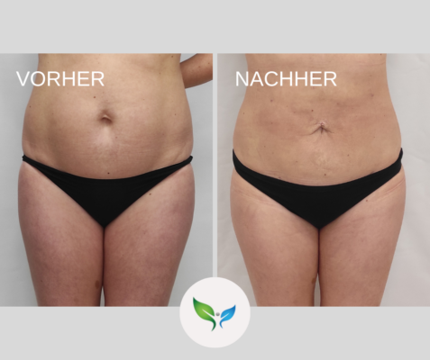 Fettabsaugung Vorher und Nachher Bilder 30 Fettabsaugung am Bauch – Vorher-Nachher Ergebnis mit schlanker Silhouette