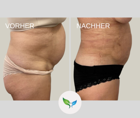 Fettabsaugung Vorher und Nachher Bilder 28 Fettabsaugung an Bauch und Hüften – deutliche Vorher-Nachher Veränderung