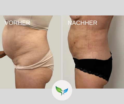 Fettabsaugung Vorher und Nachher Bilder 26 Fettabsaugung am Bauch – Vorher-Nachher Beispiel