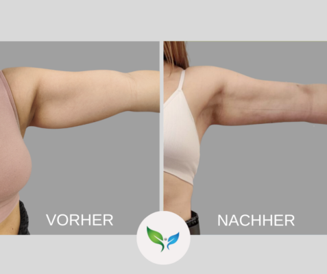 Fettabsaugung Vorher und Nachher Bilder 24 Vorher-Nachher Vergleich – Fettabsaugung Arme mit natürlichem Effekt