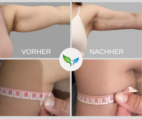 Fettabsaugung an den Armen – vorher und nachher Fotos