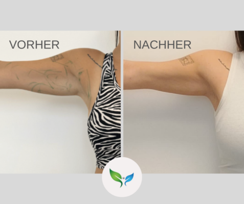 Fettabsaugung Vorher und Nachher Bilder 22 Fettabsaugung an den Armen – Vorher-Nachher Ergebnis, straffere Kontur